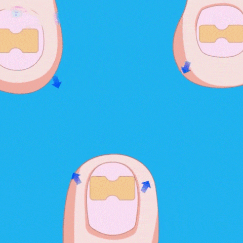 Adesivo corretor para unhas encravadas-Corrector Sticker